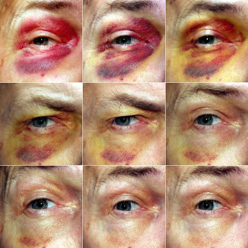 7 Gezondheidsproblemen die blauwe plekken kunnen veroorzaken en wat je eraan kunt doen